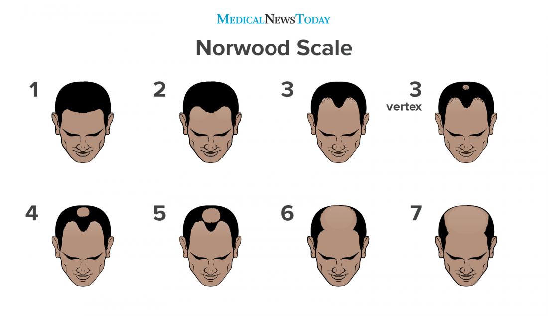 an-infographic-of-the-norwood-scale.jpg