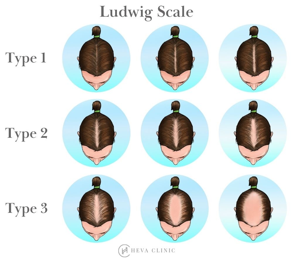 ludwig-scale-female-hair-loss-baldness-pattern.jpg